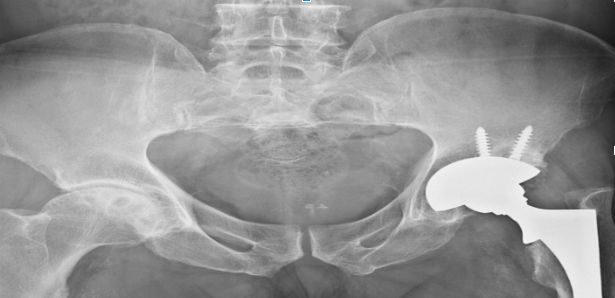 Рентген снимок в прямой проекции тазобедренной кости