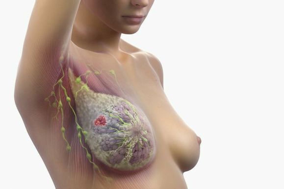 Рак груди  эффективное лечение в Испании