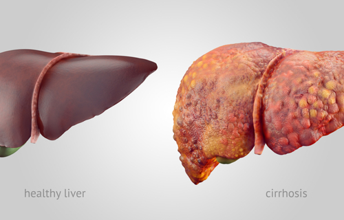 Hepatitis