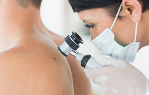 Melanoma