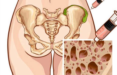 Bone marrow obtaining
