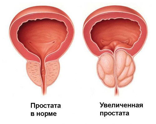 Лечение рака простаты за рубежом