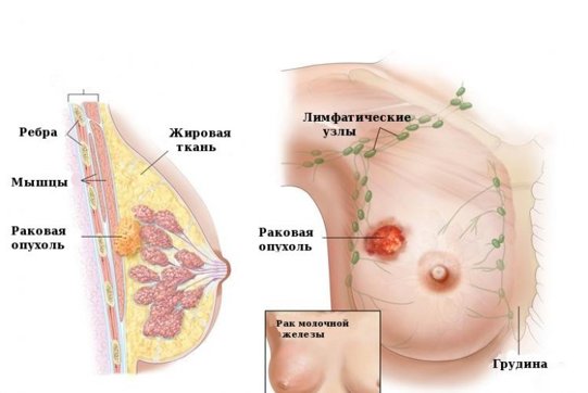 как проходит операция по удалению опухоли груди