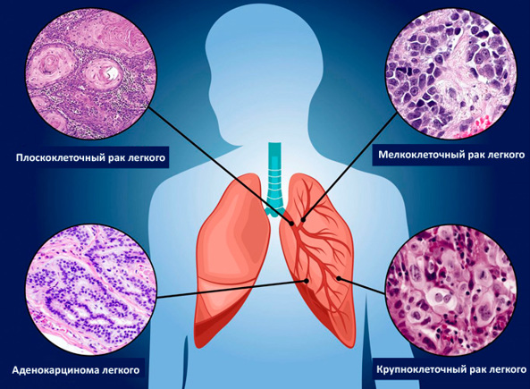 Рак лёгких 4 стадия. Диагностика, лечение и прогноз